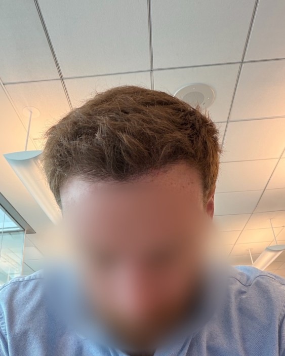 Patient 98 — 4 086 greffons, après la greffe de cheveux
