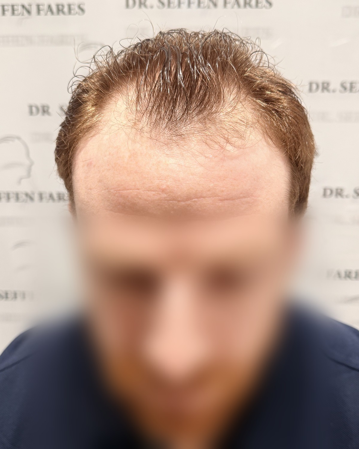 Patient 98 — 4 086 greffons, avant la greffe de cheveux